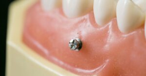 矯正用ミニインプラントを使った治療について