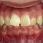 インビザライン治療 症例
