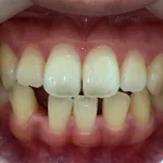 インビザライン治療 症例