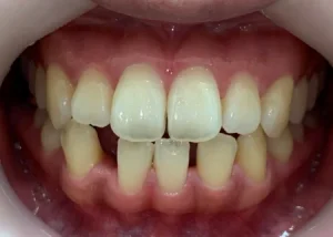 インビザライン治療　症例