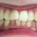 インビザライン治療 症例