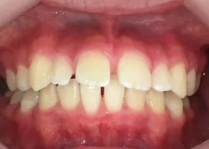 インビザライン治療　症例