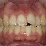 インビザライン治療 症例