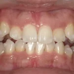 ホワイトニング 症例