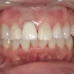 ホワイトニング 症例
