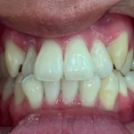 インビザライン治療　症例