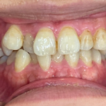 インビザライン治療 症例