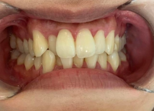 インビザライン治療　症例