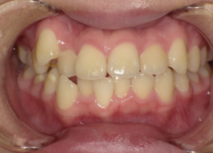 インビザライン治療　症例