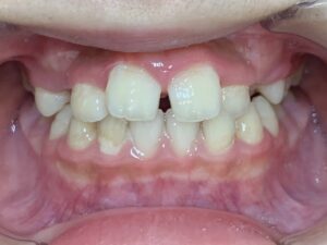 小児矯正　症例