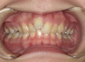 インビザライン治療　症例