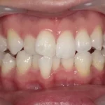 ホワイトニング　症例