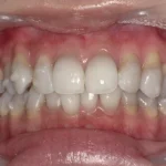 ホワイトニング 症例