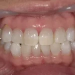 ホワイトニング 症例