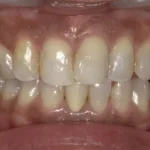 ホワイトニング 症例
