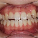 インビザライン治療　症例