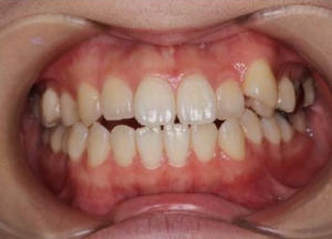 インビザライン治療　症例