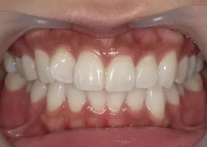 ホワイトニング　症例