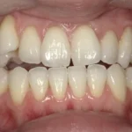 ホワイトニング　症例