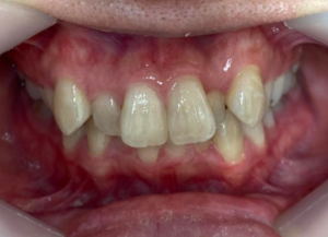 インビザライン治療　症例