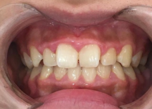 インビザラインGO治療　症例