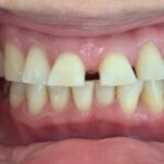 インビザライン治療　症例