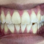 インビザライン治療 症例