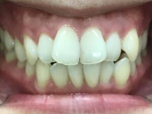 インビザライン治療　症例