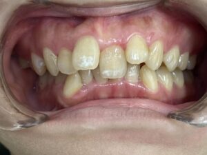インビザライン治療　症例