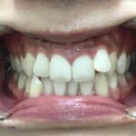 インビザライン治療 症例
