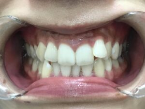 インビザライン治療　症例