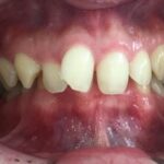 インビザライン治療　症例