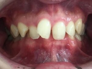 インビザライン治療　症例