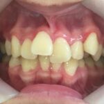 インビザライン治療 症例