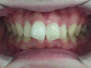 インビザライン治療　症例