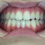インビザラインGO治療　症例