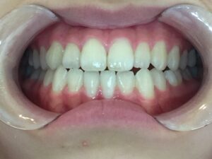 インビザラインGO治療　症例