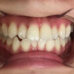 インビザライン治療 症例