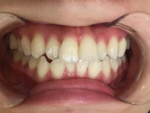 インビザライン治療　症例