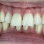 インビザライン治療　症例