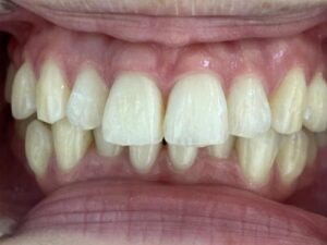 インビザライン治療　症例