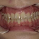 インビザライン治療 症例