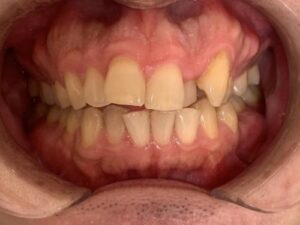 インビザライン治療　症例