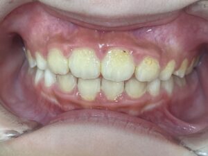 小児矯正　症例