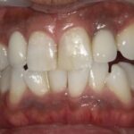 ホワイトニング 症例