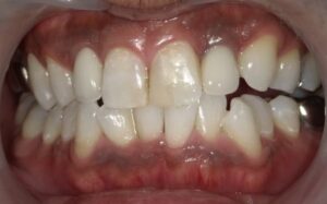 ホワイトニング　症例