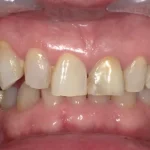 ホワイトニング 症例