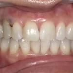 ホワイトニング　症例