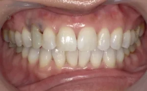 ホワイトニング　症例