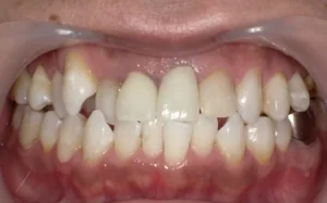 ホワイトニング　症例